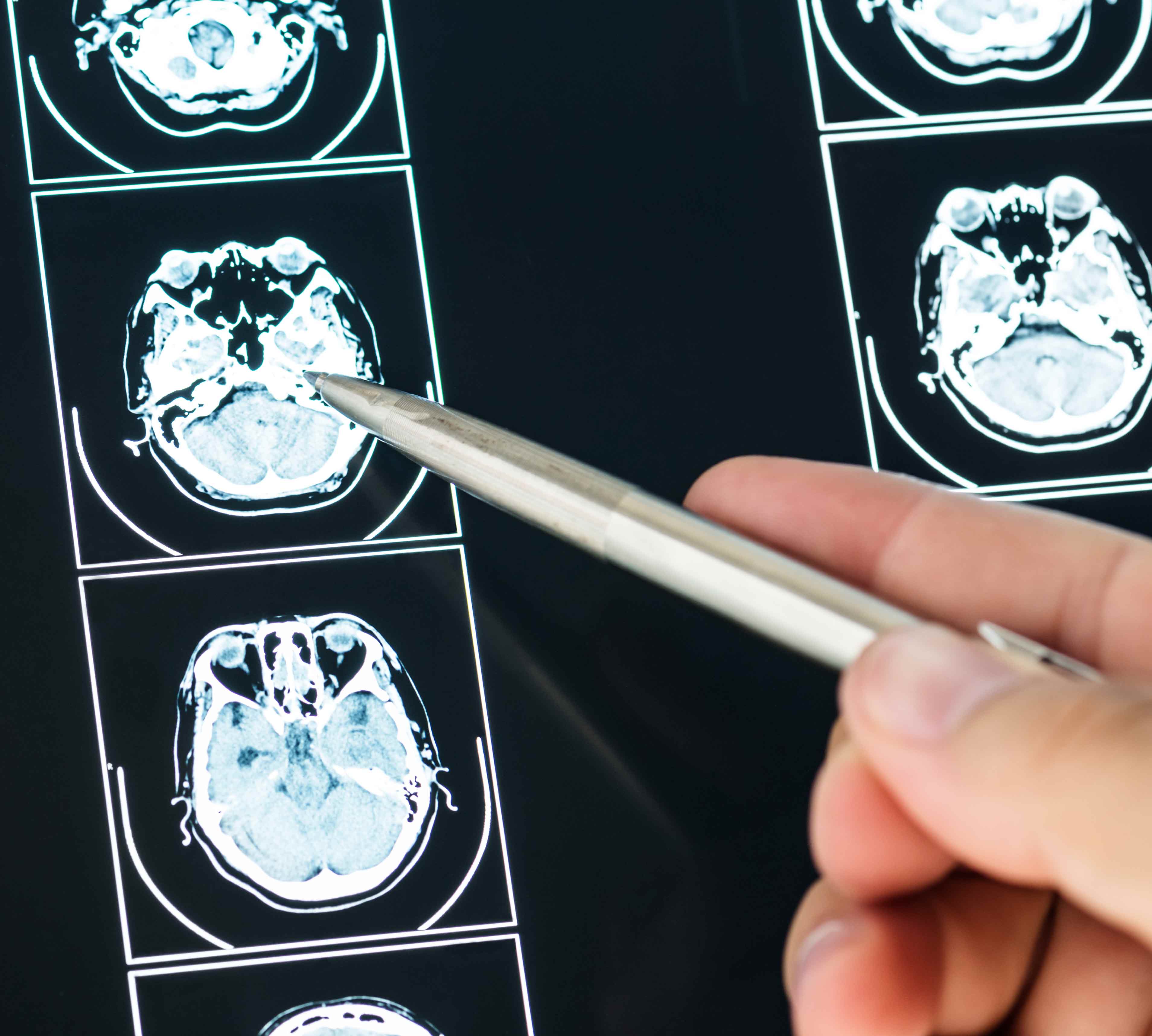 Brain Tumor: Symptoms, Causes and Treatments. | BlueNetHospitals Los Cabos